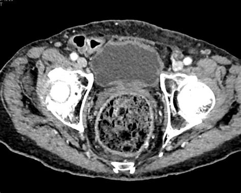 Stercoral Colitis - Colon Case Studies - CTisus CT Scanning