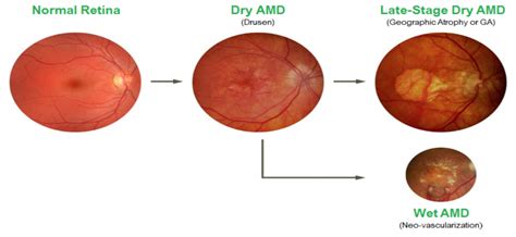 Age-related Macular Degeneration (AMD) & Low Vision - Best Optometrist Dr. Jeff Sciberras