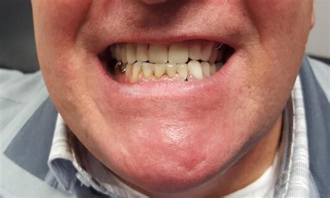 Southside Dental Center's Smile Gallery | Upper and Lower Partial Dentures, Crowns, and Fillings.