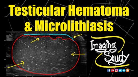 Testicular Hematoma & Microlithiasis || Ultrasound || Case 205 - YouTube