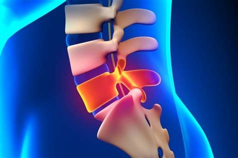 Bulging Disc L4/L5 - Symptoms and Treatment