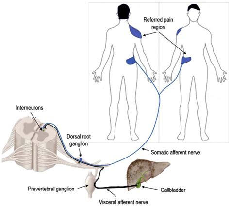 Visceral Pain: Mechanisms, Syndromes, and Treatment | Anesthesia Key