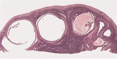 Pathology Outlines - Polycystic ovary disease