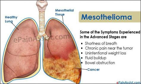 Pin on Mesothelioma