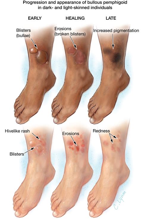 Bullous Pemphigoid | Dermatology | JAMA Dermatology | The JAMA Network