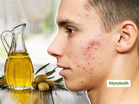 Olive Oil Benefits For Skincare: Get Rid Of Facial Blemishes For A ...