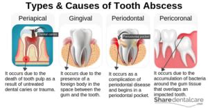 Tooth Abscess Treatment: Relief from Pain & Infection - Share Dental Care