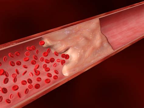 CKD Risk Reported to Rise in Step with Calcium Buildup in Coronary Arteries - CKD News