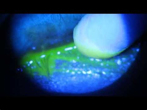 Scraping PseudoMembrane from under Eyelid with Adenovirus Infection ...