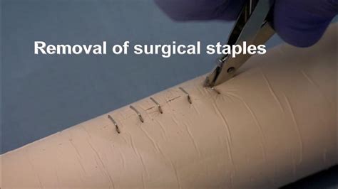 Placing and removing surgical wound closure staples - YouTube