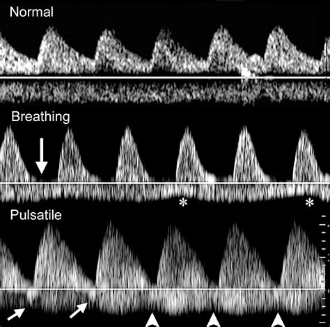 A Radiologist’s Guide to the Performance and Interpretation of Obstetric Doppler US | RadioGraphics