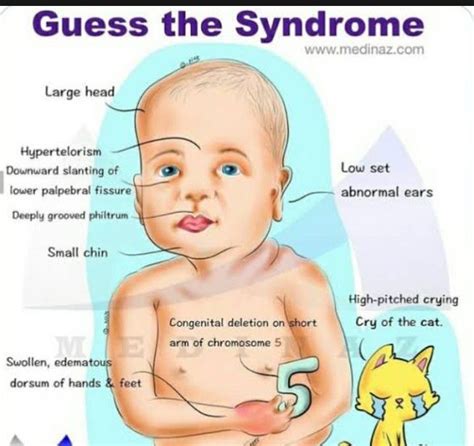 Cri-Du-chat Syndrome - MEDizzy