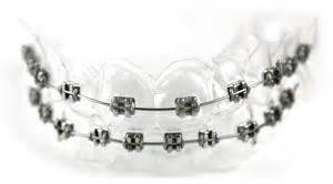 FakeBraces.net: Custom Fake Orthodontic Braces for your Teeth ($200-500) - Svpply | Fake braces ...