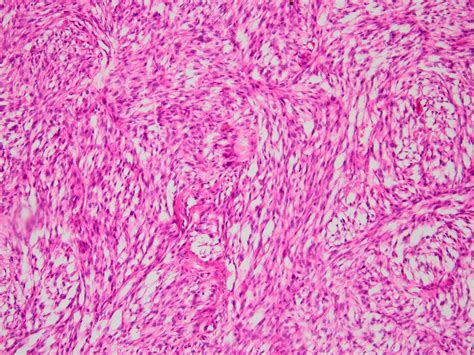 Pathology Outlines - Clear cell sarcoma