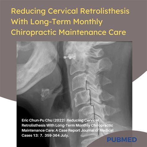 Eric Chun-Pu Chu (2022) Reducing Cervical Retrolisthesis With Long-Term Monthly Chiropractic ...