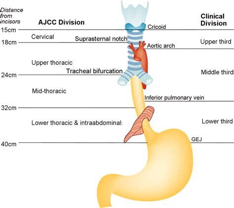 Multimodality Assessment of Esophageal Cancer: Preoperative Staging and ...