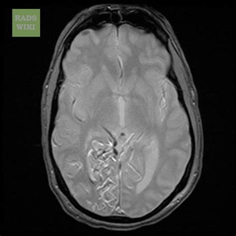 Arteriovenous malformations MRI - wikidoc