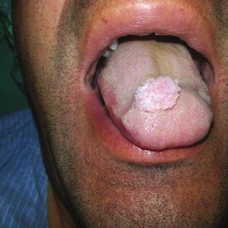 (PDF) Verruca vulgaris of the tongue: A case report with literature review