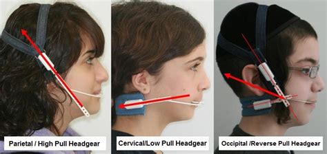 Uses of Orthodontic Headgear With Braces - Headgear Braces