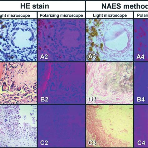 (PDF) Evaluation of Crystals in Formalin-Fixed, Paraffin-Embedded Tissue Sections for the ...