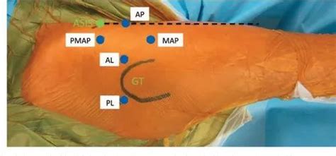 Avascular Necrosis Of Hip Surgery in Chennai | ID: 20973631433