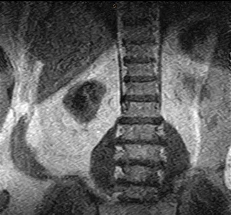 Lumbar Spine: Lumbar Spine Without Contrast