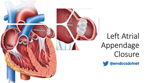 emDOCs.net – Emergency Medicine EducationLeft atrial appendage closure: procedure basics ...