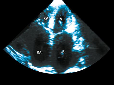 Figure 031_4106. Echocardiography (apical 4-chamber view) of a patient with restrictive ...