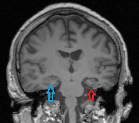 Hippocampal sclerosis causes, symptoms, diagnosis & treatment