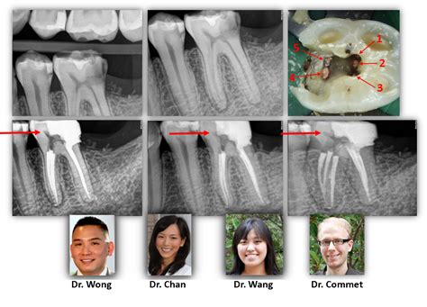 MINIMALLY INVASIVE ENDODONTICS/RESTORATIVE DENTISTRY? | Renovo ...