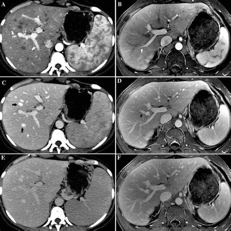 LI-RADS technical requirements for CT, MRI, and contrast-enhanced ultrasound | Request PDF