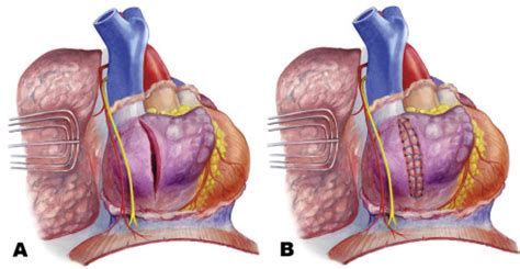 Surviving Right Atrial Rupture From Blunt Thoracic Trauma After Pericardiectomy - The Annals of ...