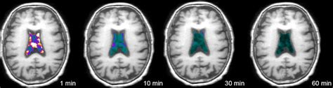 Brain Fluid Clearance After Traumatic Brain Injury Measured Using ...