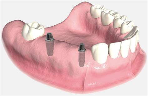 Fixed Implant Bridges (non-removable)