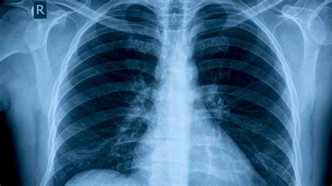 Copd Lung Chest X Ray