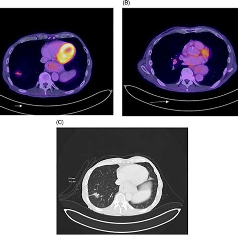 A suggested approach to biopsy from suspicious lung nodule or... | Download Scientific Diagram