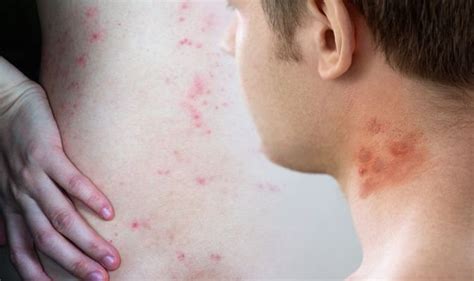 Eczema rash: Pus-filled bumps could indicate a skin infection | Express.co.uk