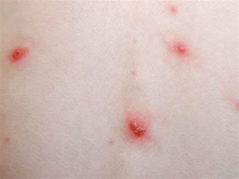 Chickenpox Causes Picture Symptoms And Treatment - vrogue.co