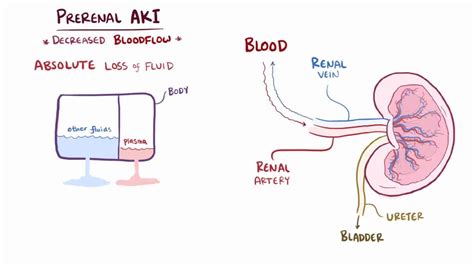 Prerenal azotemia: Video, Anatomy & Definition | Osmosis