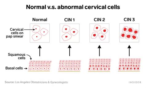 Why an abnormal Pap smear doesn't always mean you have cancer | Business Insider India