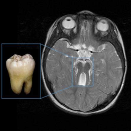 Joubert Syndrome is characterized by a specific finding on an MRI called a "molar tooth sign" in ...