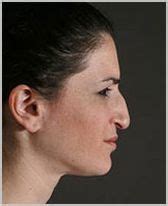 Before & After Rhinoplasty New York NY | Alan Matarasso MD | Page 1