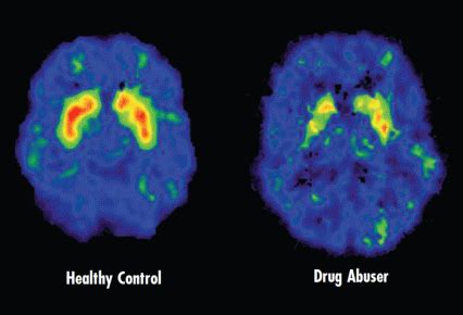 How do drugs affect the brain? – Families for Addiction Recovery