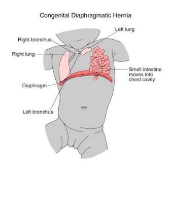 Congenital Diaphragmatic Hernia - Fetal Health Foundation