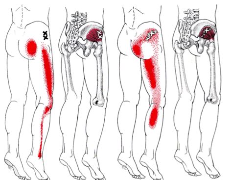 Sciatic nerve pain | Causes, symptoms and treatment