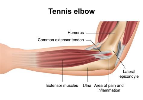 Tennis Elbow | Tennis Elbow Treatment | Tennis Elbow Symptoms