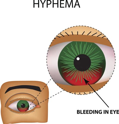 What is Hyphema? - Facty Health