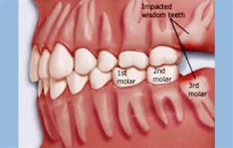 Wisdom Tooth Extraction, डेंटल ट्रीटमेंट सर्विस in Indore, Ideal Dental Care | ID: 7531670773