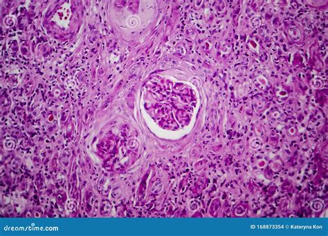 Chronic Glomerulonephritis, Light Micrograph Stock Photo - Image of histology, medicine: 168873354