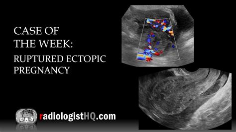 Ruptured Ectopic Pregnancy Ultrasound